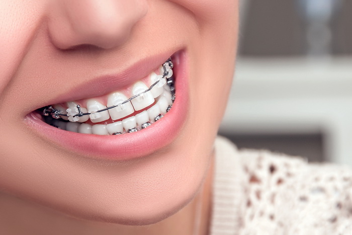 сколько стоят брекеты на зубы
