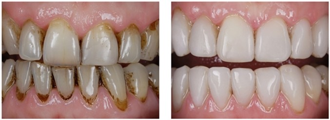 ультрозвуковая чистка зубов