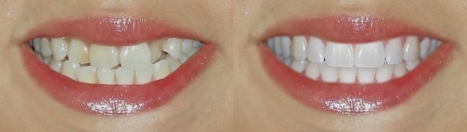 результат реставрации зубов в стоматологии