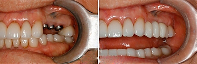 подробное фото во время операции (синус-лифтинга)