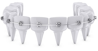 ИСПРАВЛЕНИЕ ПРИКУСА